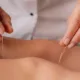 Acupuncture for Stress and Anxiety Relief: An Overview