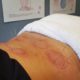 Sports Recovery Acupuncture: Explore 6 Essential Benefits