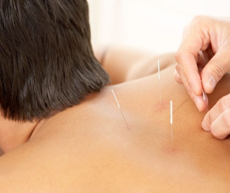 Acupuncture and Cupping for Enhanced Sports Recovery